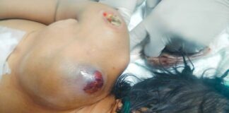 Sungguh Kasihan Nasip Anak 2 Tahun Jadi Korban Pemasangan Infus CVC yang Salah di RSUD Kalabahi, Pembulu Dara Vena dan Arteri Rusak, Hingga Dirujuk Ke Kupang dan Akan ke Jakarta